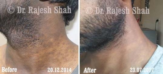 Lichen Planus Pigmentosa Before and After Case Photo