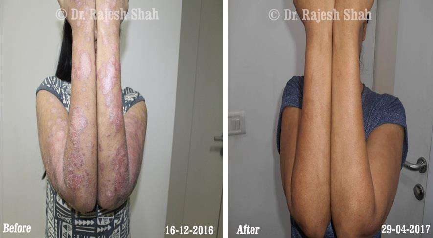 Psoriasis Before and After Case Photo