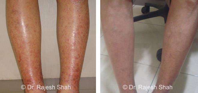 Psoriasis Before and After Case Photo