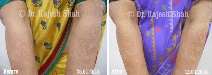 Psoriasis Before and After Case Photo