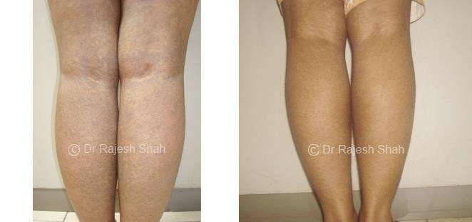 Lichen Planus Before and After Case Photo