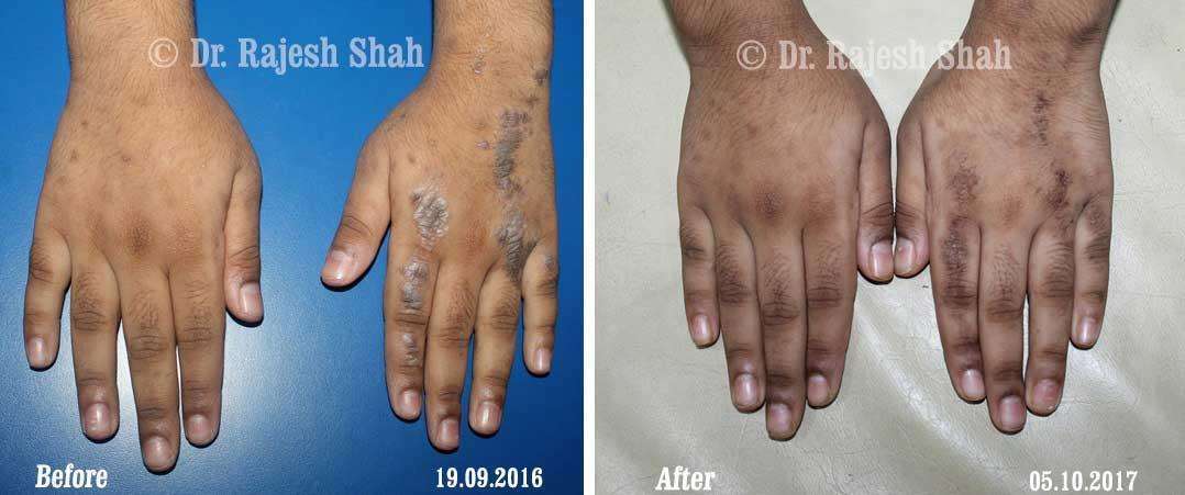 Lichen Planus Before and After Case Photo