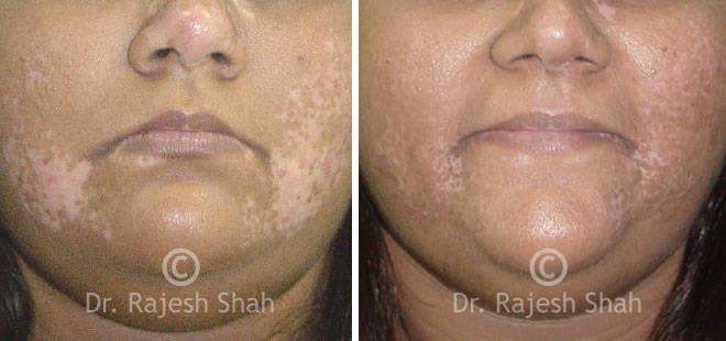 Vitiligo Before and After Case Photo
