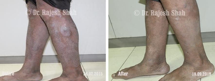 Psoriasis Before and After Case Photo