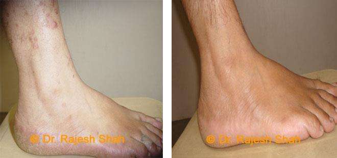 Psoriasis Before and After Case Photo