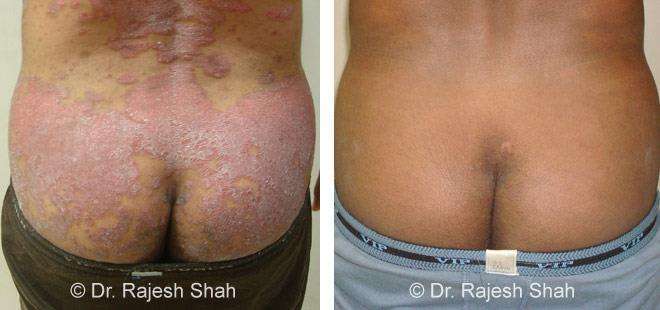 Psoriasis Before and After Case Photo