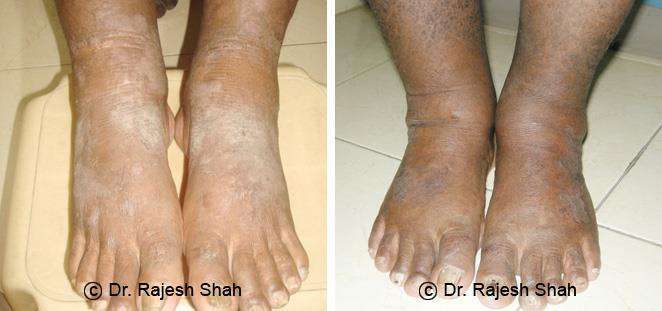 Eczema Before and After Case Photo