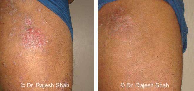 Psoriasis Before and After Case Photo