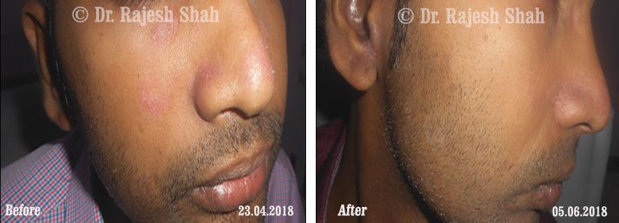 Psoriasis Before and After Case Photo