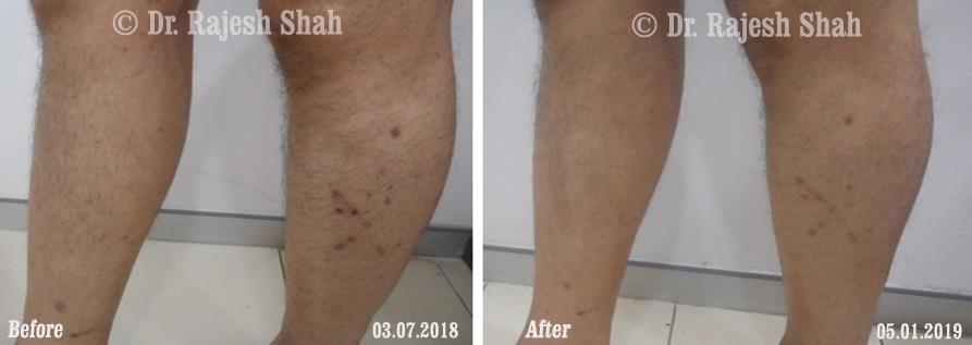 Lichen Planus Before and After Case Photo