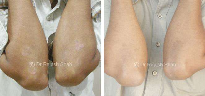 Psoriasis Before and After Case Photo