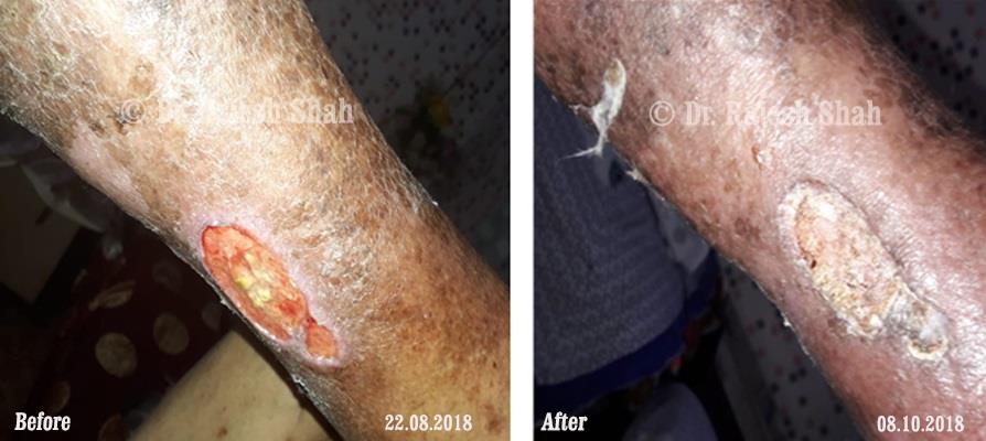 Non-healing ulcers Before and After Case Photo