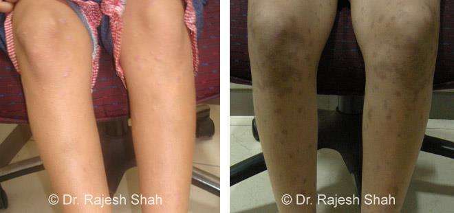 Lichen Planus Before and After Case Photo