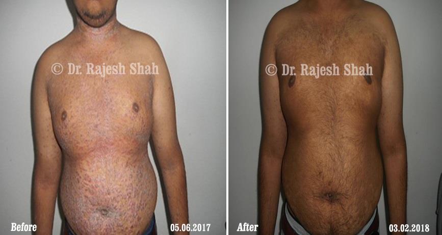 Psoriasis Before and After Case Photo