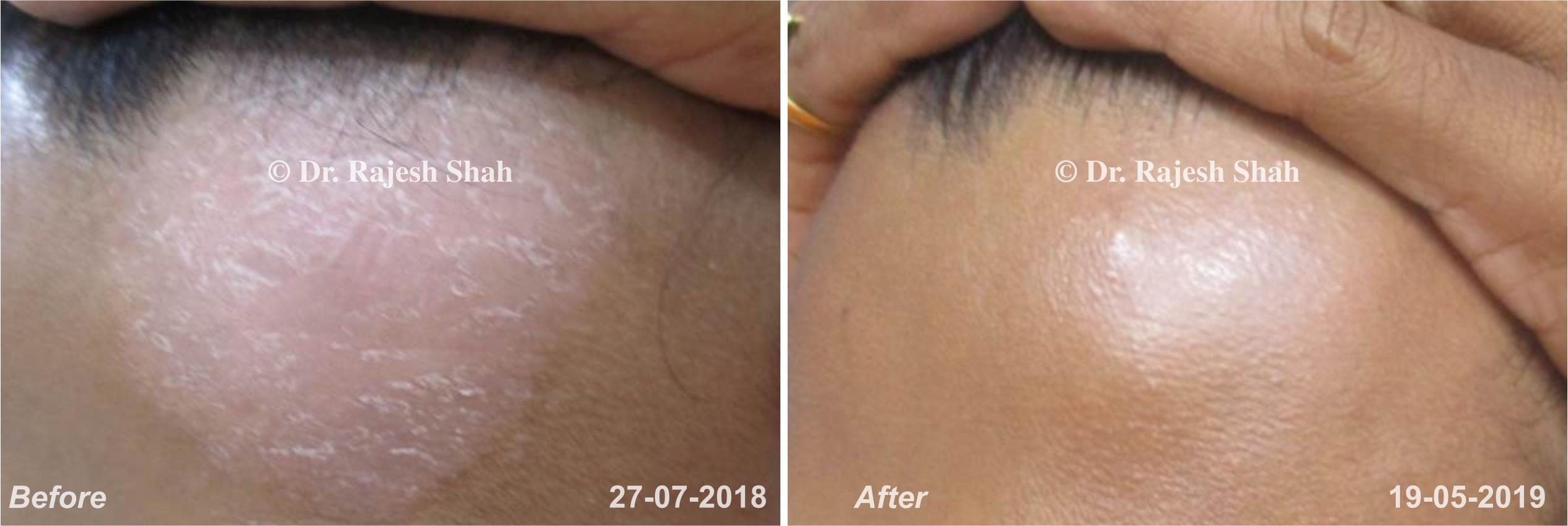 Psoriasis Before and After Case Photo