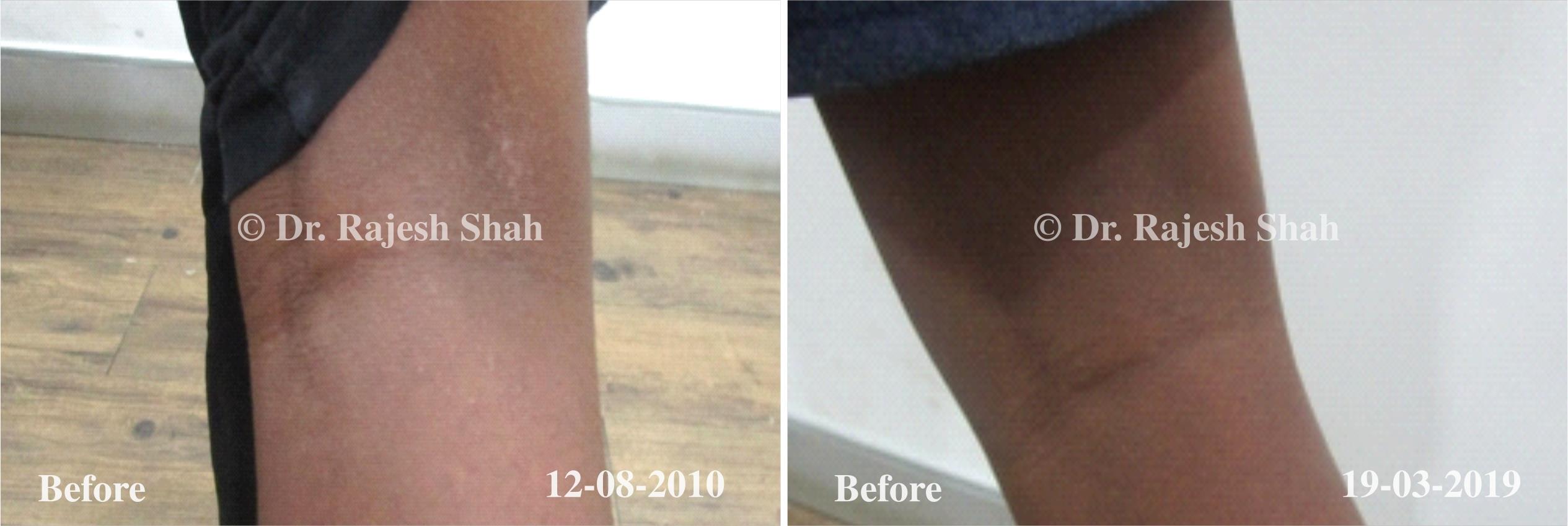 Eczema Before and After Case Photo