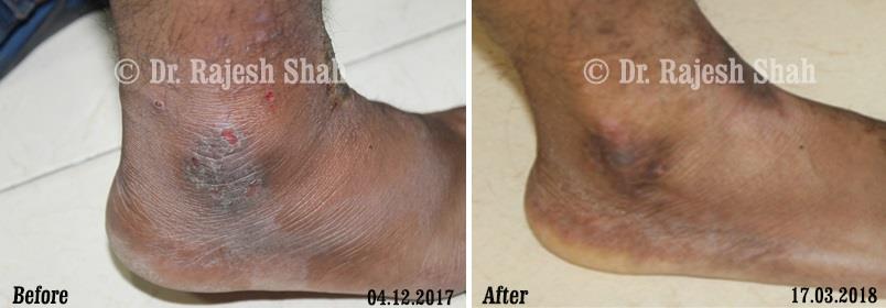 Eczema Before and After Case Photo