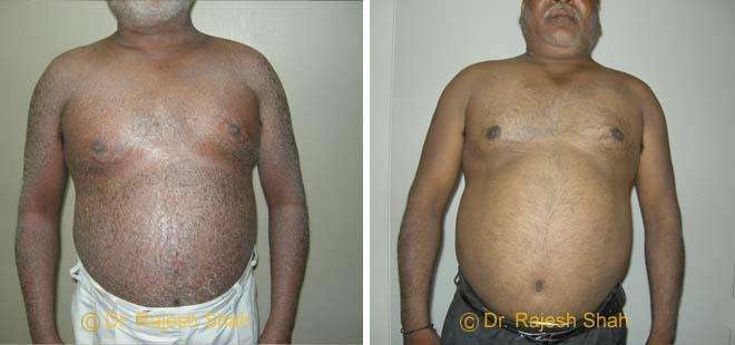 Psoriasis Before and After Case Photo