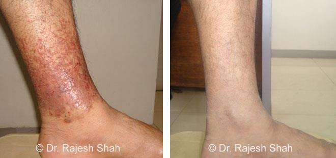 Eczema Before and After Case Photo