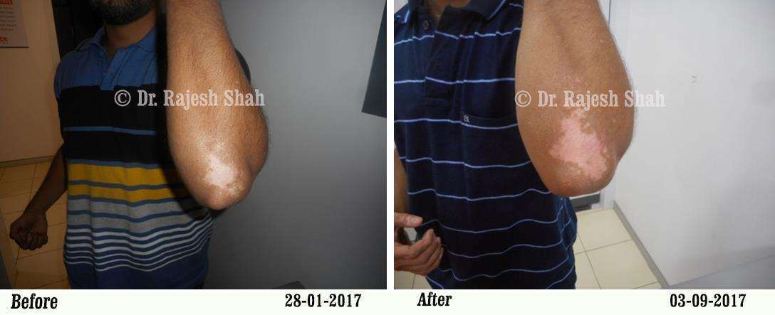 Vitiligo Before and After Case Photo