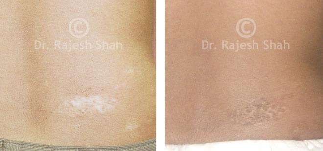 Vitiligo Before and After Case Photo