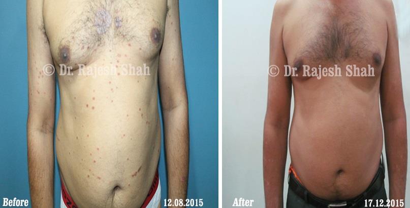 Psoriasis Before and After Case Photo