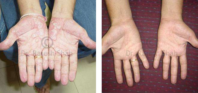 Psoriasis Before and After Case Photo