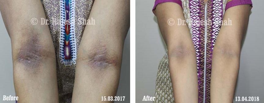 Prurigo Nodularis Before and After Case Photo