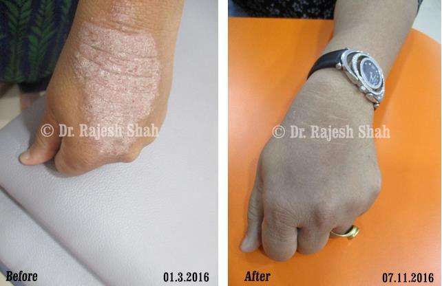 Psoriasis Before and After Case Photo