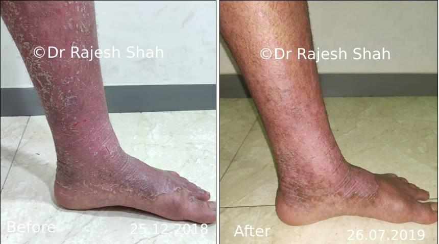 Psoriasis Before and After Case Photo