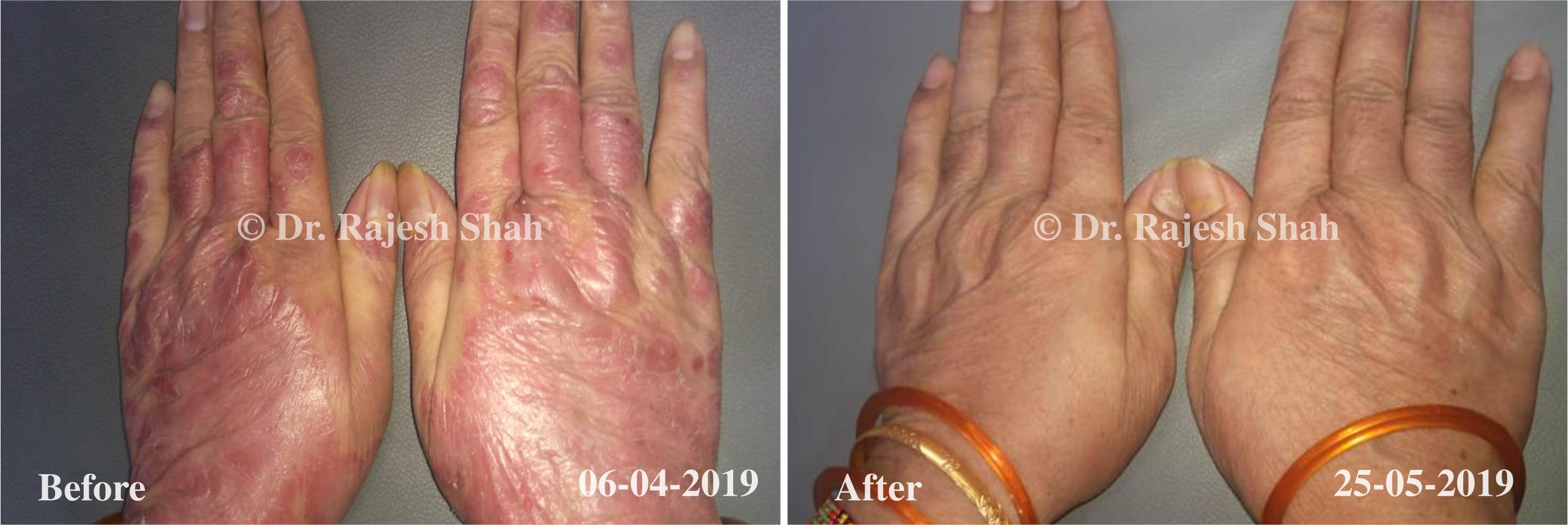 Psoriasis Before and After Case Photo
