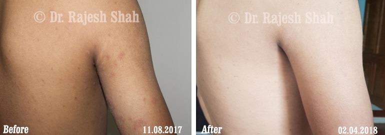 Lichen Planus Before and After Case Photo