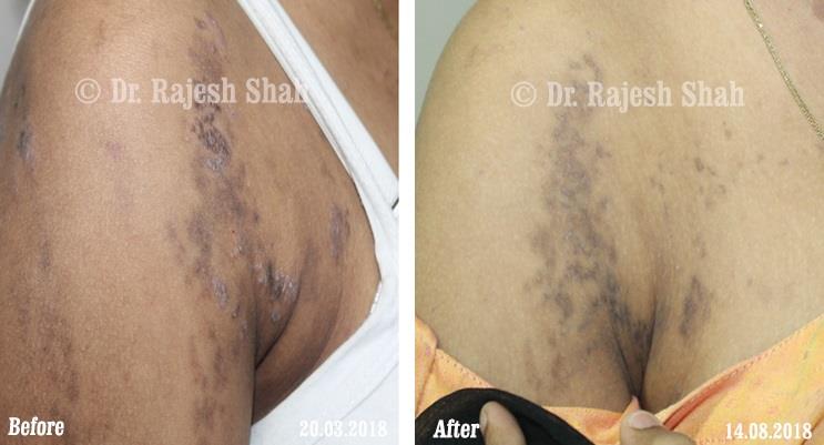 Lichen Planus Before and After Case Photo