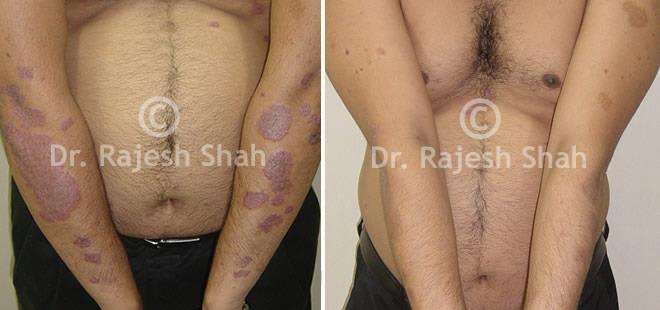 Psoriasis Before and After Case Photo