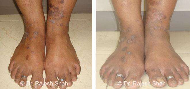 Lichen Planus Before and After Case Photo