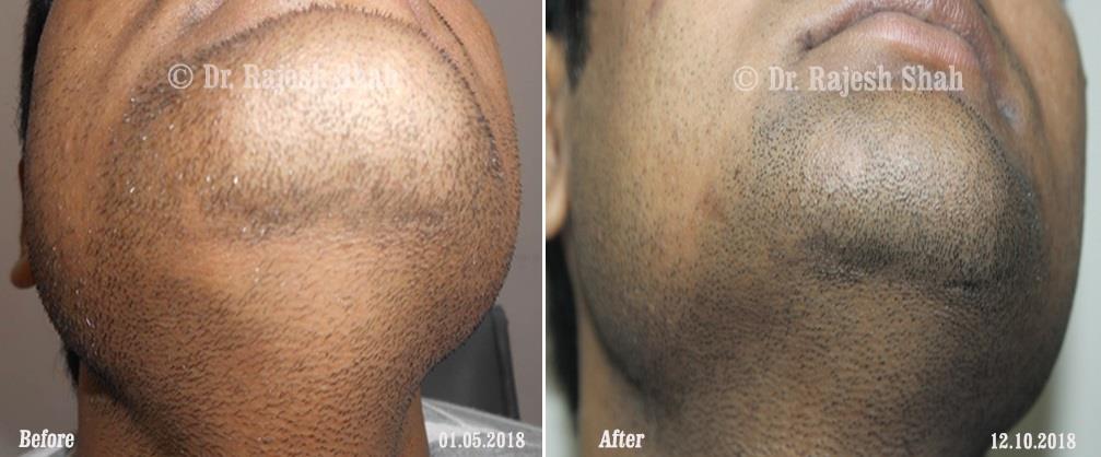 Alopecia Areata Before and After Case Photo