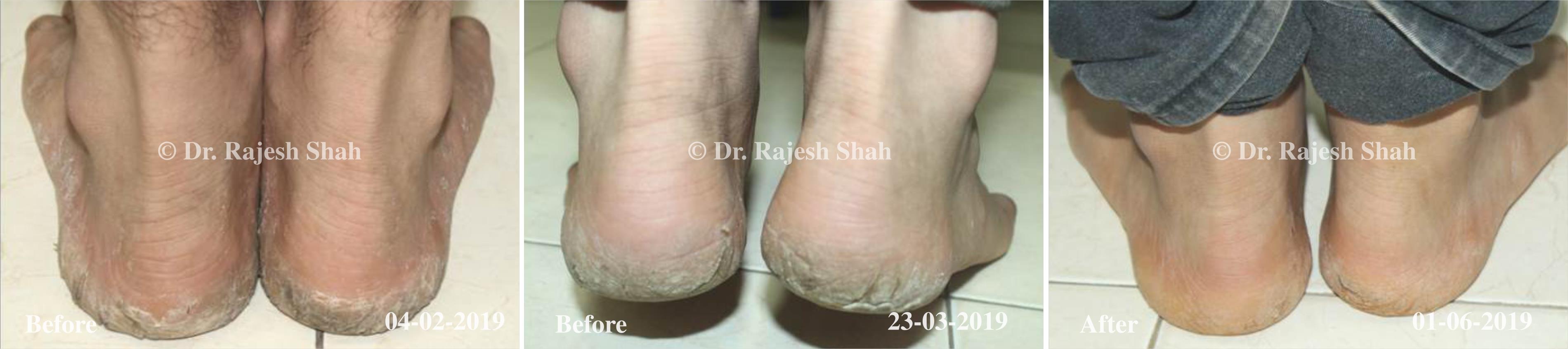 Psoriasis Before and After Case Photo