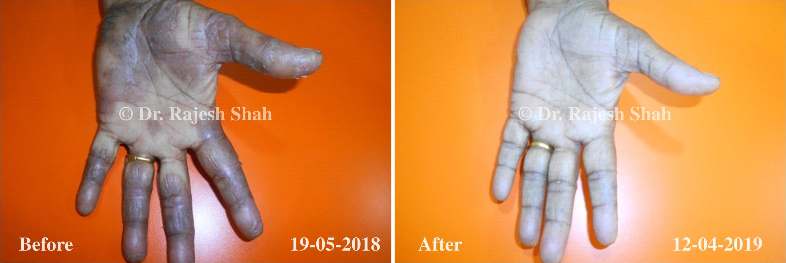 Psoriasis Before and After Case Photo