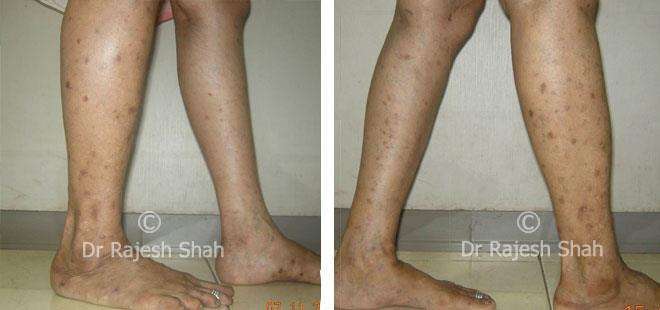 Lichen Planus Before and After Case Photo