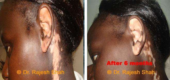 Vitiligo Before and After Case Photo