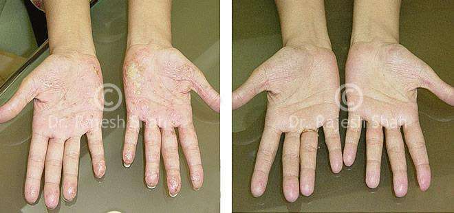Psoriasis Before and After Case Photo