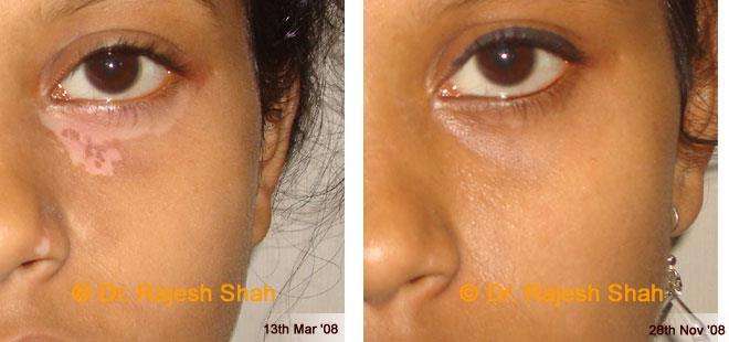 Vitiligo Before and After Case Photo