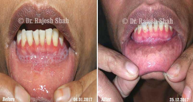Lichen Planus Before and After Case Photo