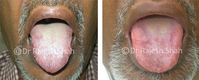 Lichen Planus Before and After Case Photo