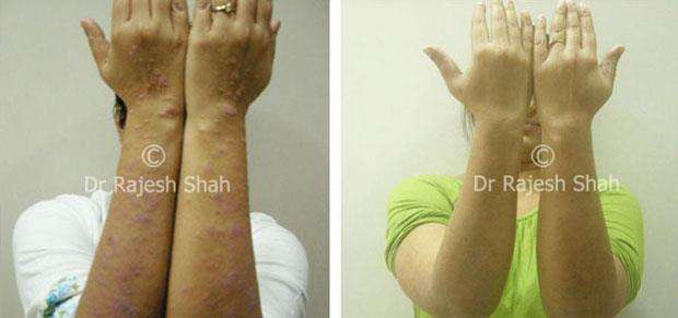 Lichen Planus Before and After Case Photo