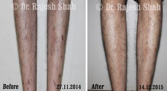 Lichen Planus Before and After Case Photo