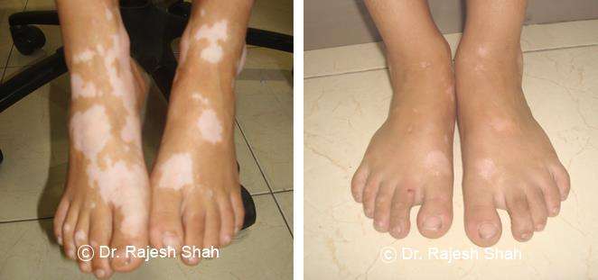 Vitiligo Before and After Case Photo