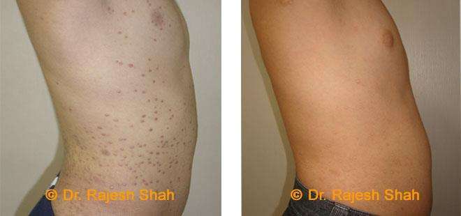 Lichen Planus Before and After Case Photo