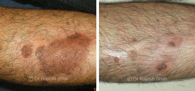 Psoriasis Before and After Case Photo