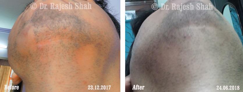 Alopecia Areata Before and After Case Photo